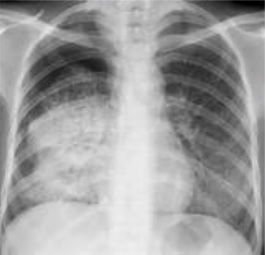 Dense_opacity_of_primary_pulmonary_tuberculosis.jpg