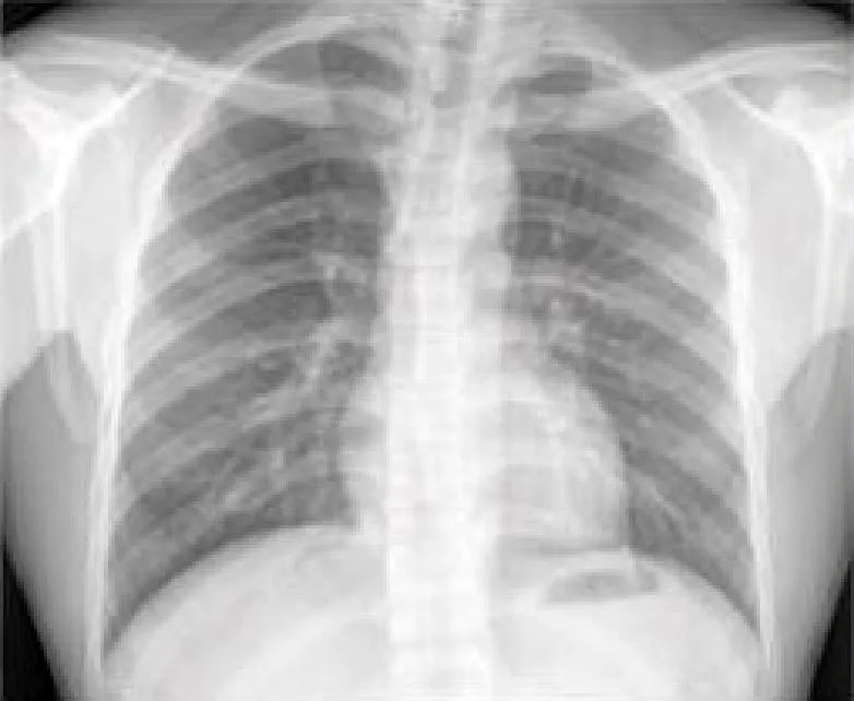 Normal-Chest-X-Ray.webp