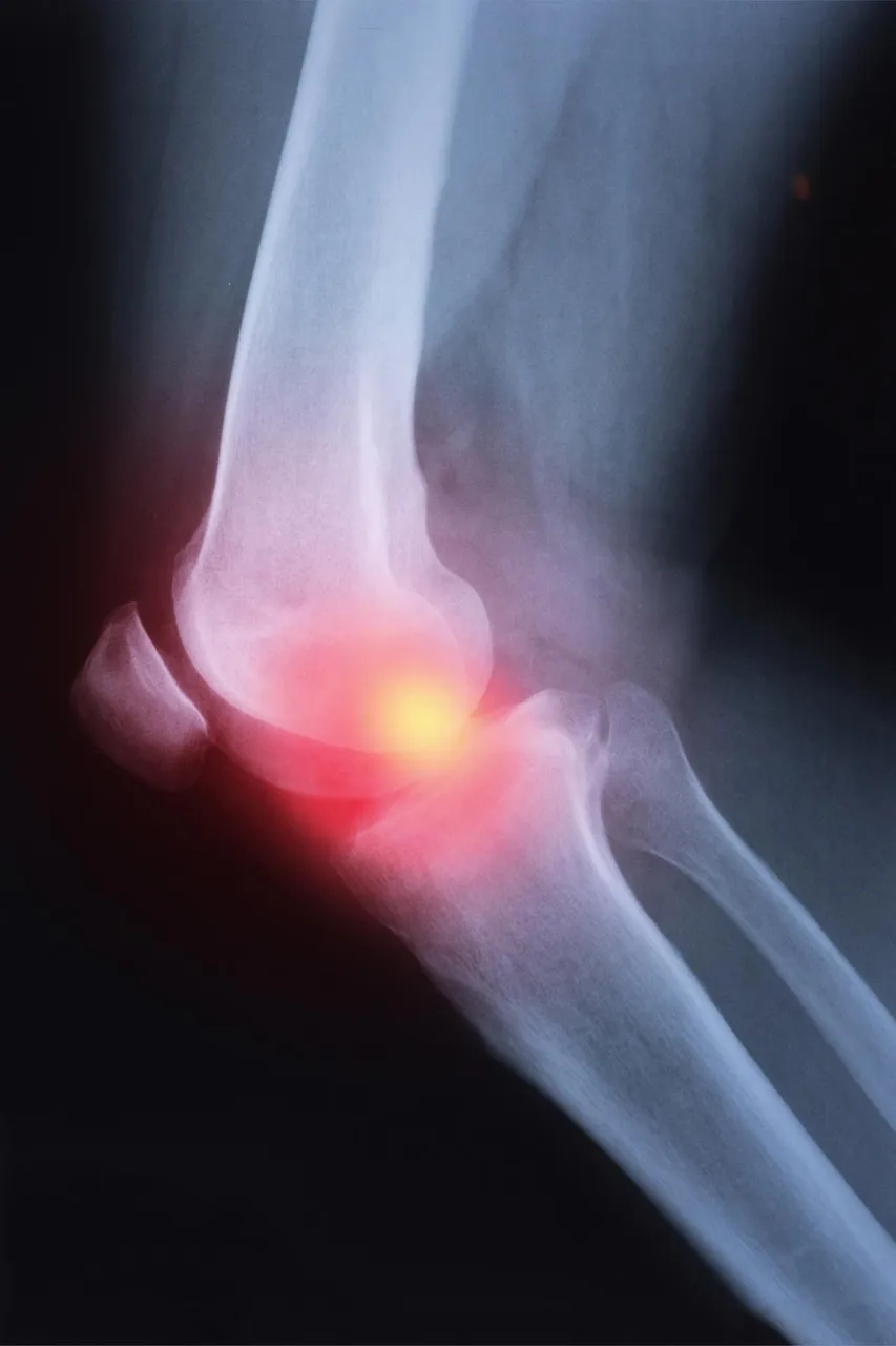 Knee-Pain-Arthritis-X-ray.webp