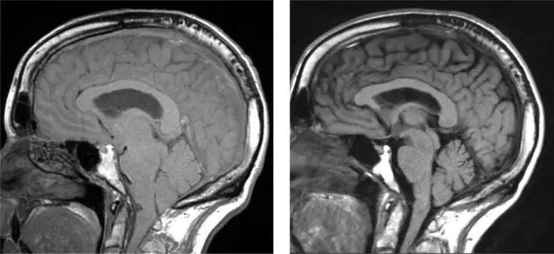 Brain-Sagging-777x357.webp
