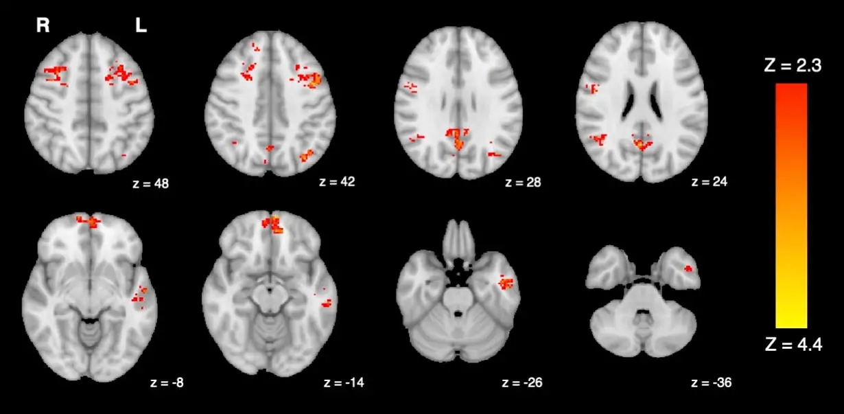 fMRI-Shows-Decreased-Functional-Connectivity-in-the-Brain-Following-Exposure-to-Traffic-Pollution.webp