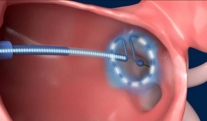 Medtronic_Pulsed_Field_Ablation_system_May_2020_0.webp