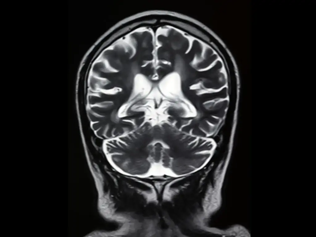 Front-Brain-Scan-MRI-Image.webp