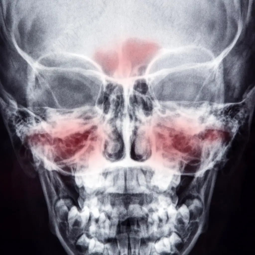 Skull-X-ray-Sinusitis-Inflammation-Sinuses.webp