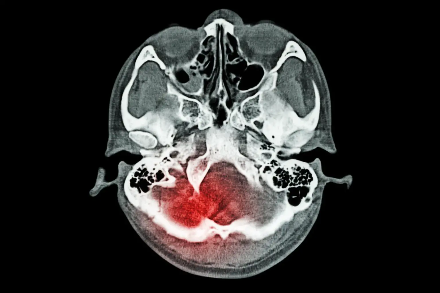 Brain-Injury-Stroke-Concept-1536x1024.webp
