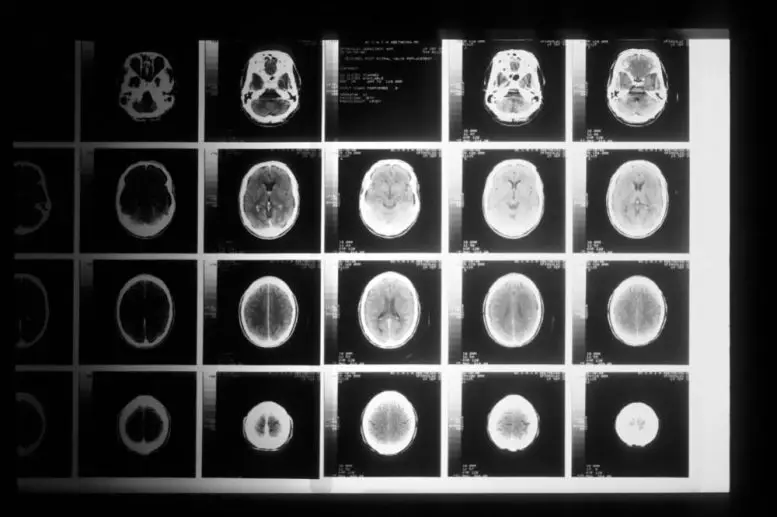 Compounds-Inhibit-Growth-of-Brain-Tumor-Cells-777x517.webp