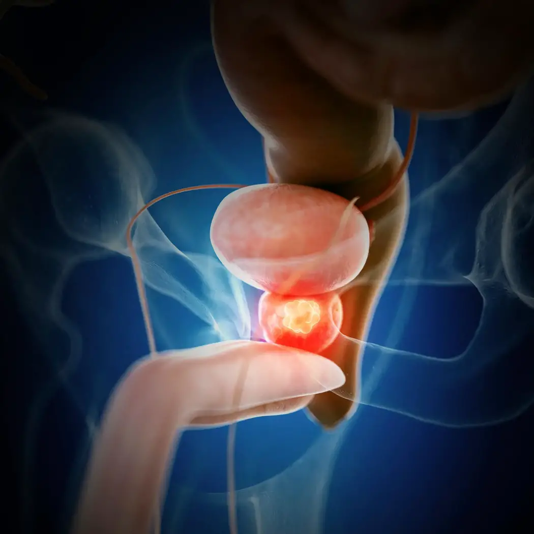 Prostate-Cancer-Illustration.webp