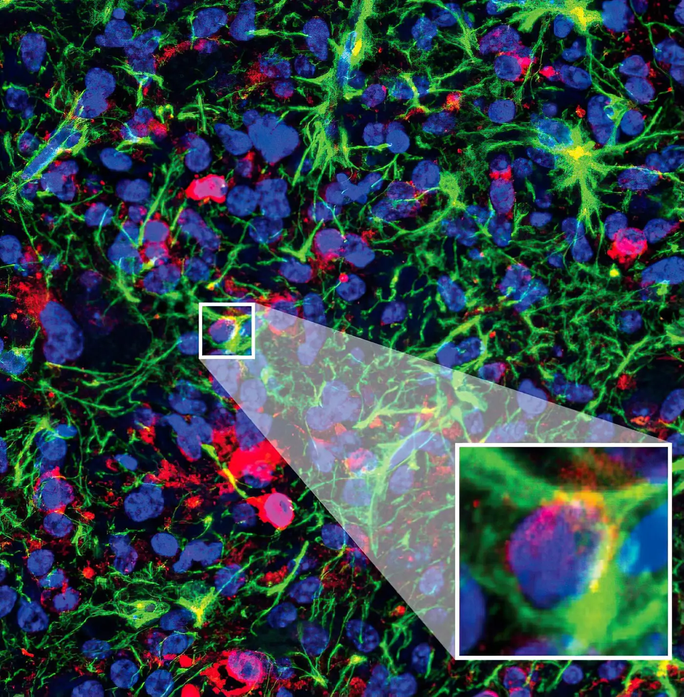 Glioma-Stains-Zoom.webp