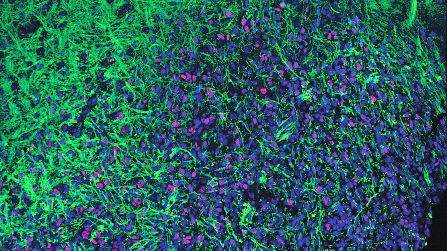 Glioma-Stains.webp