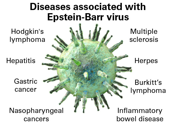 Blog_Epstein-barr_virus_8682_T.jpg