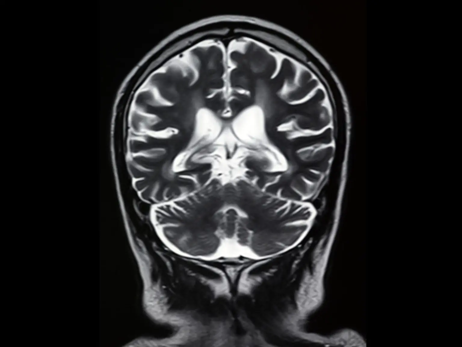 Front-Brain-Scan-MRI-Image-1536x1152.webp