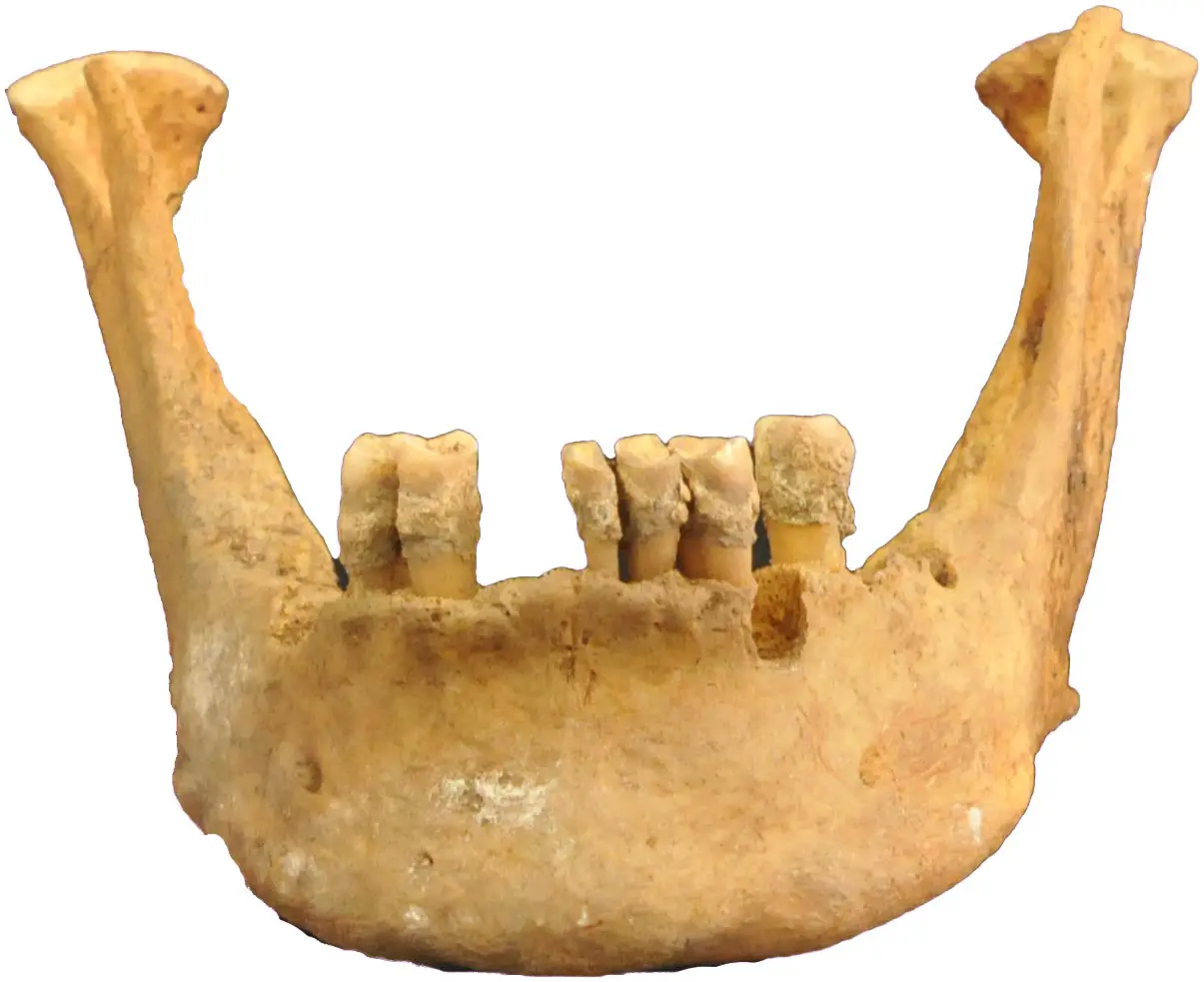Highest-Altitude-Dental-Calculus.webp