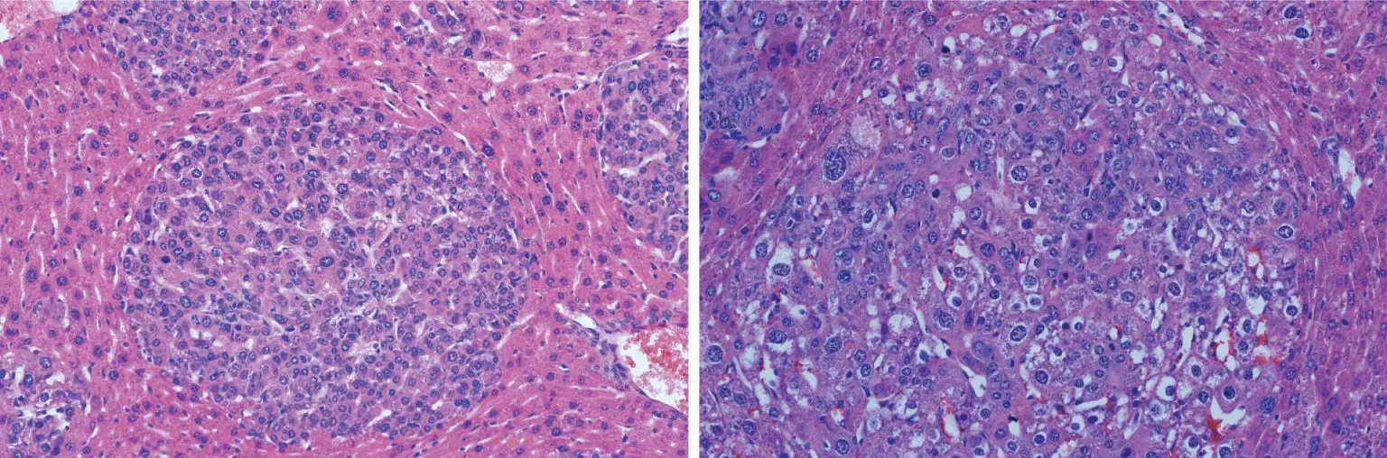 Liver-Tumor-Subtypes-1536x508.webp