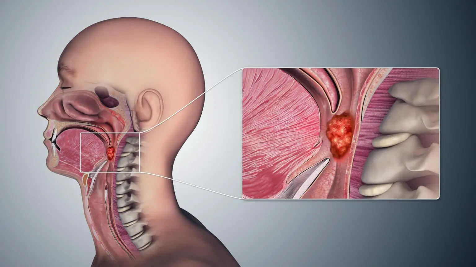 Oropharyngeal-Cancer-Throat-1536x864.webp