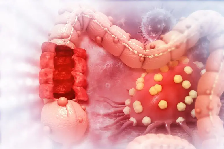 Colon-Cancer-Illustration-777x518.webp