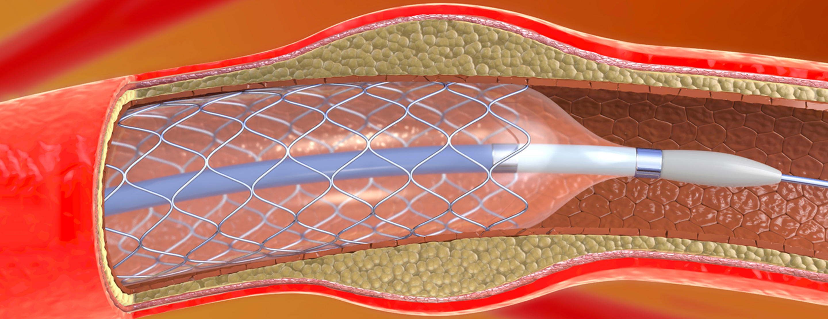 percutaneous-coronary-intervention-pci-2x.jpg