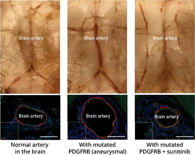 First-Drug-Treatment-for-Aneurysm.webp