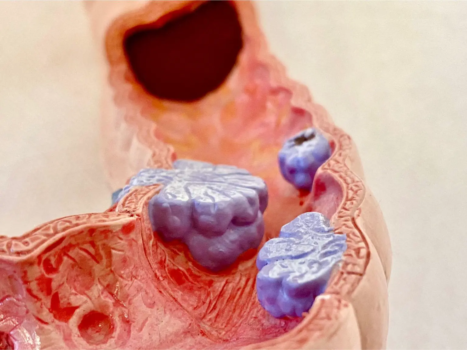 Anatomical-Model-Colon-Cancer-1536x1152.webp
