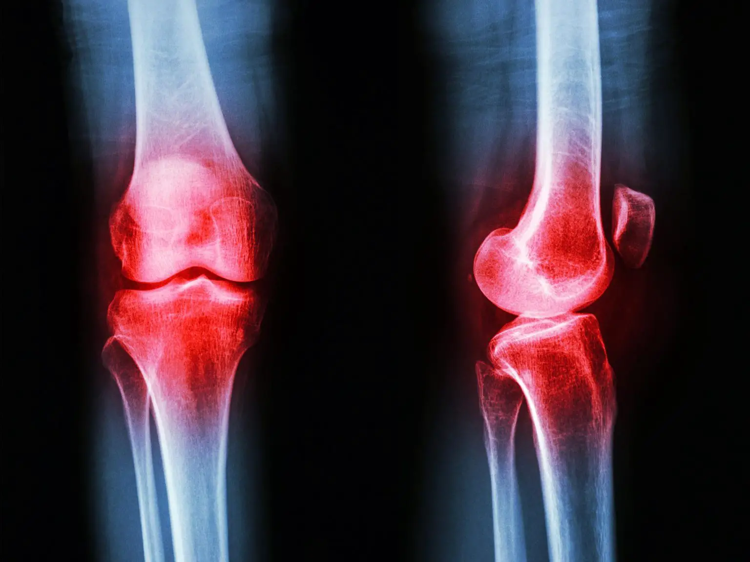 Osteoarthritis-Knee-Inflammation-1536x1152.webp