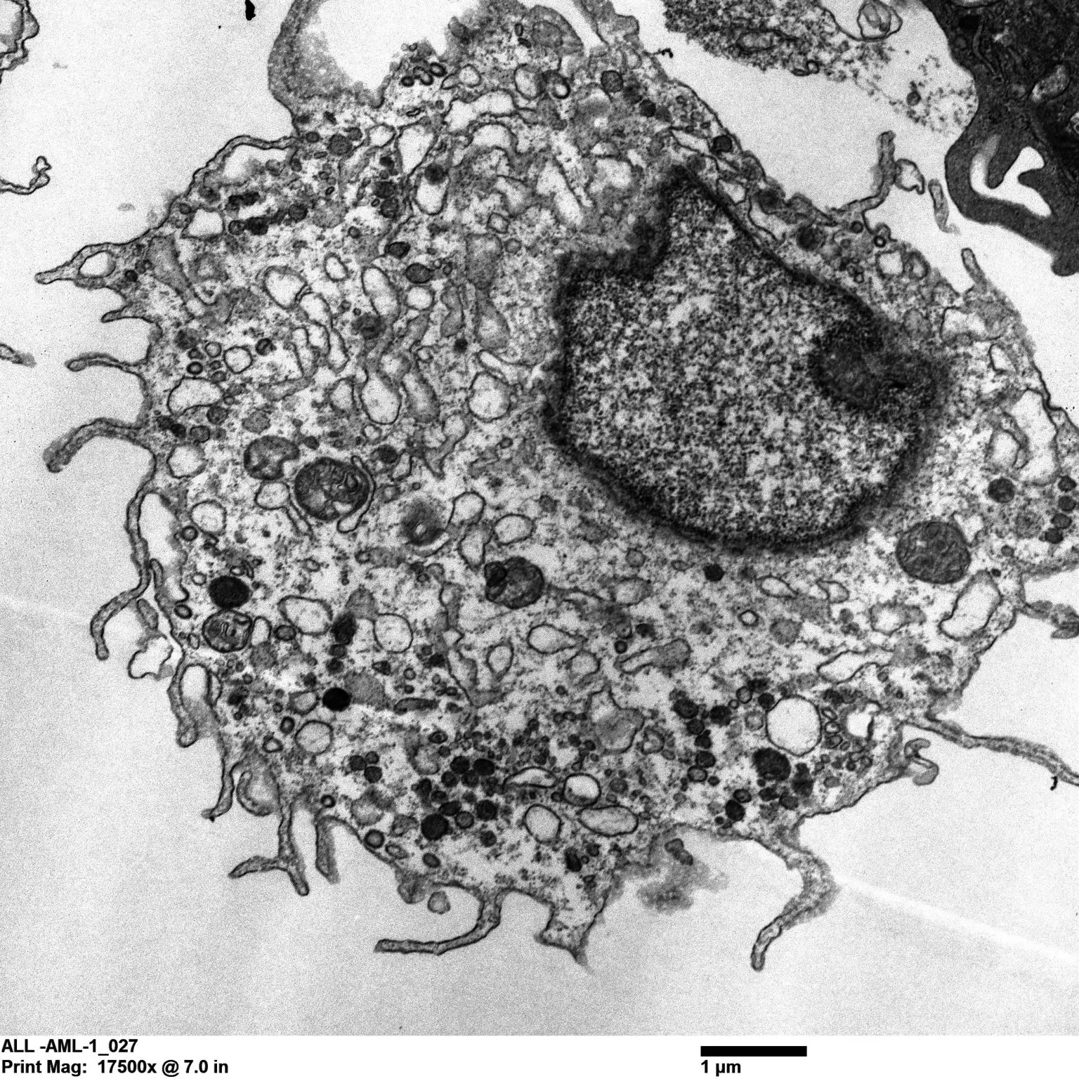 AML-Cell-TEM-Image-1536x1536.webp