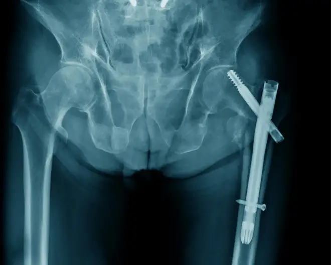 Hip-Fixation-Bone-Fracture.webp