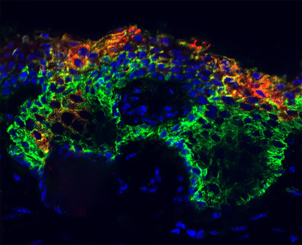 Lesions-Akin-to-Basal-Cell-Carcinoma-That-Were-Induced-by-SOX9-in-the-Epidermis.webp