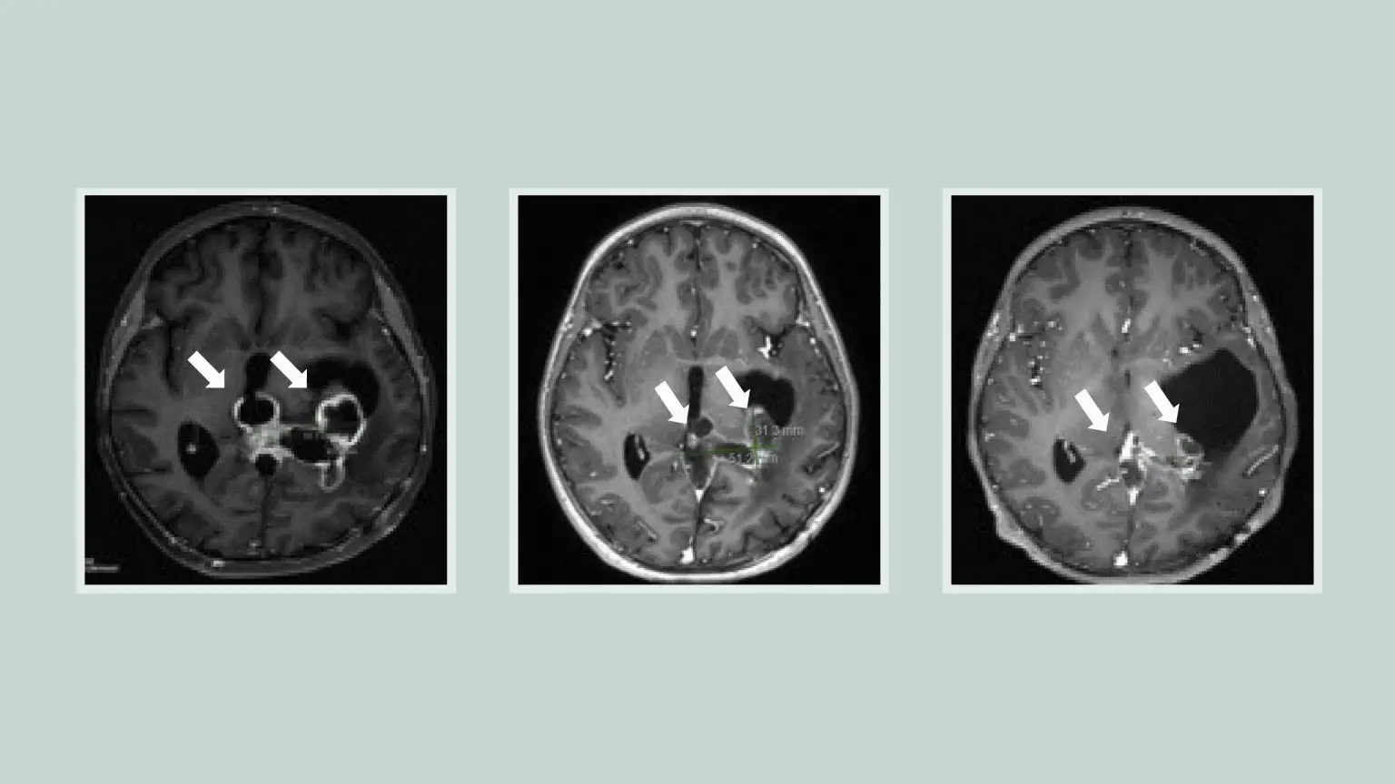 Tumor-Response-ONC201-1536x864.webp