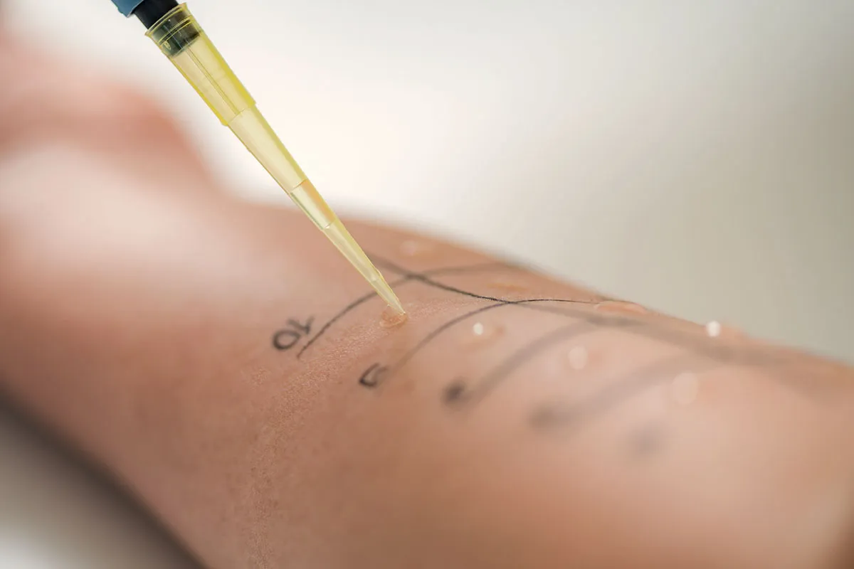 closeup-shot-of-skin-prick-test-to-learn-of-the-allergy_Cr_microgen_Envato.webp