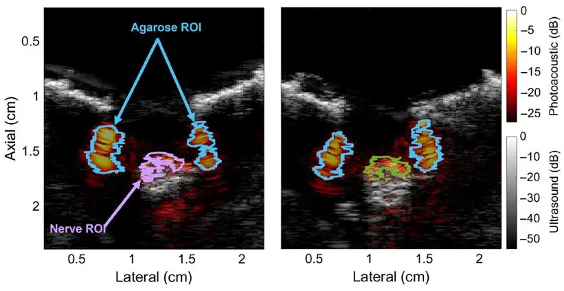 Photoacoustic-Images-of-Ulnar-and-Median-Nerves.webp