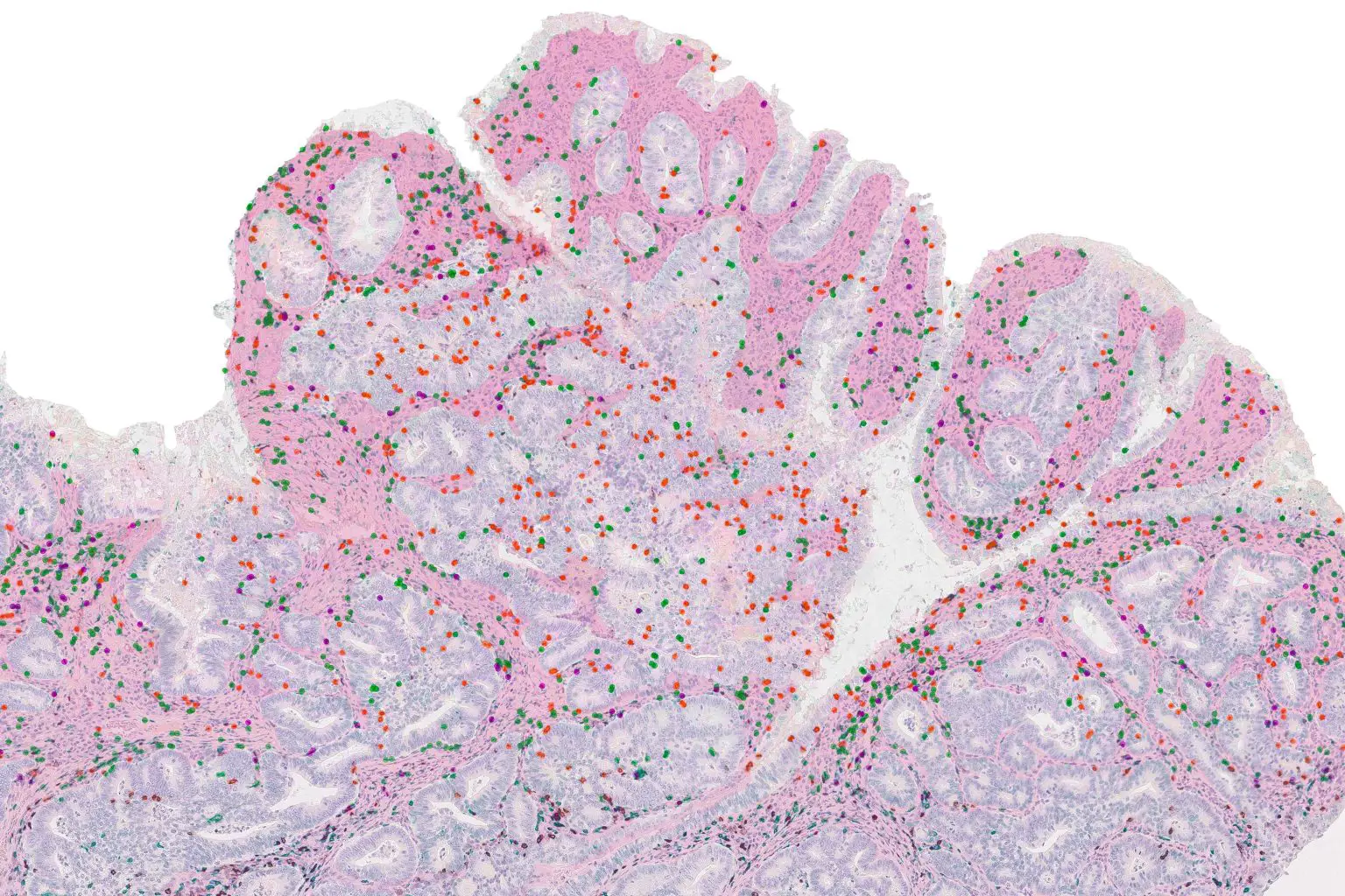 Colon-Tumor-DNA-Mismatch-Repair-Deficiency-1536x1024.webp
