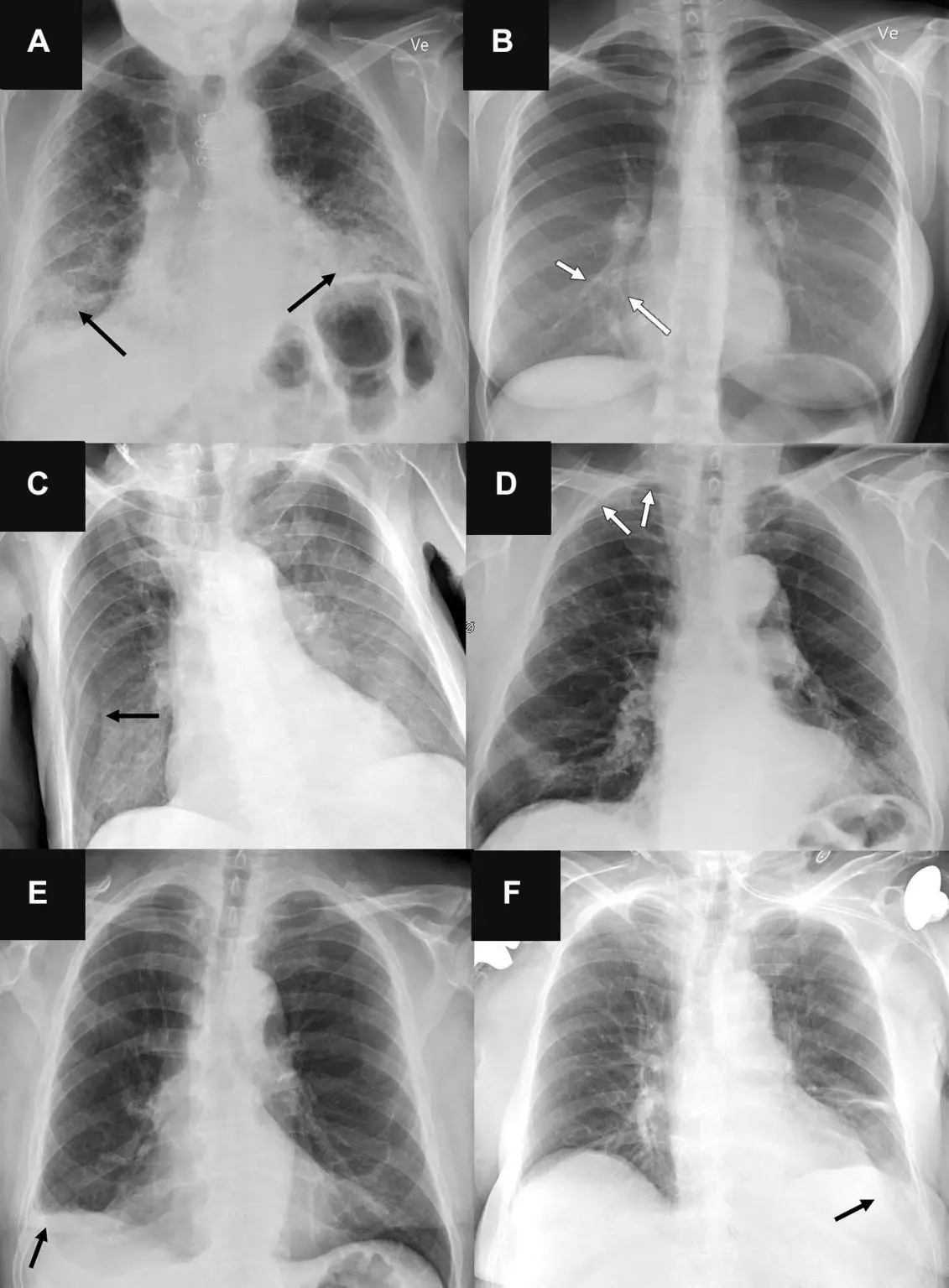 Artificial-Intelligence-Tools-Representative-Chest-Radiographs-in-Six-Patients-1131x1536.webp