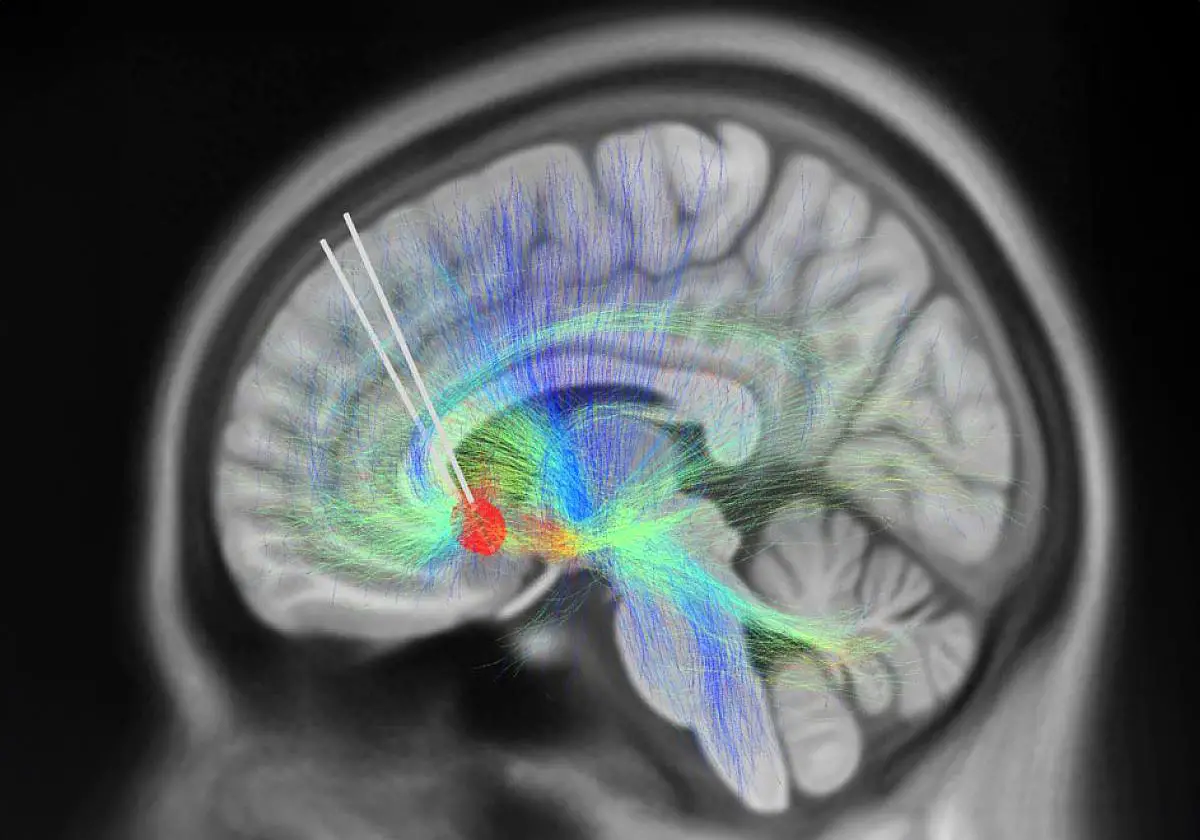 DBS-Leads-Implanted-Into-Subcallosal-Cingulate-Cortex.webp