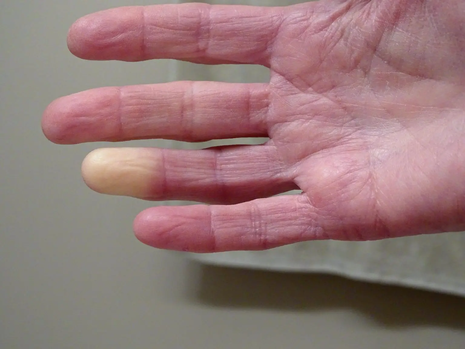 Raynauds-Phenomenon-1536x1152.webp