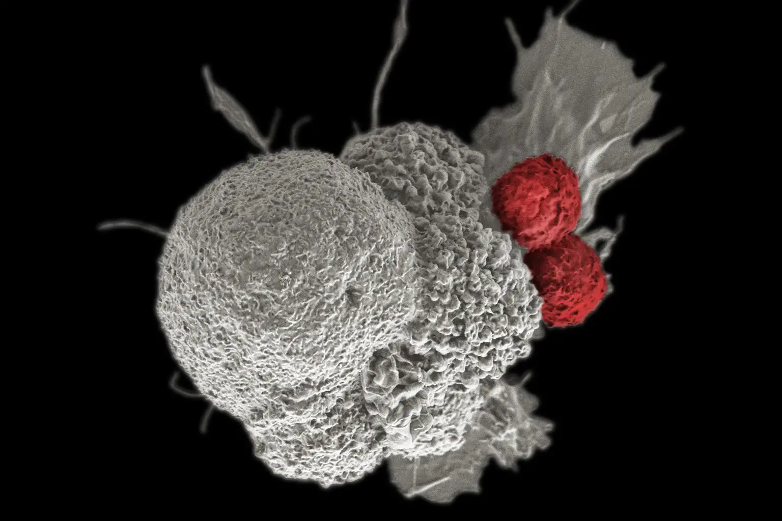 Oral-Squamous-Cancer-Cell-1536x1024.webp