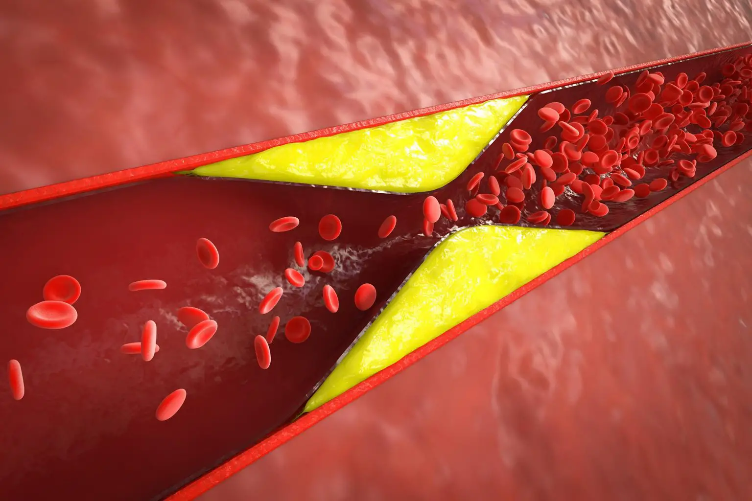 Atherosclerosis-With-Plaque-in-Vessel-1536x1024.webp