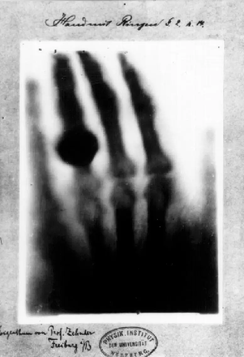First-Medical-X-Ray-by-Wilhelm-Rontgen.webp