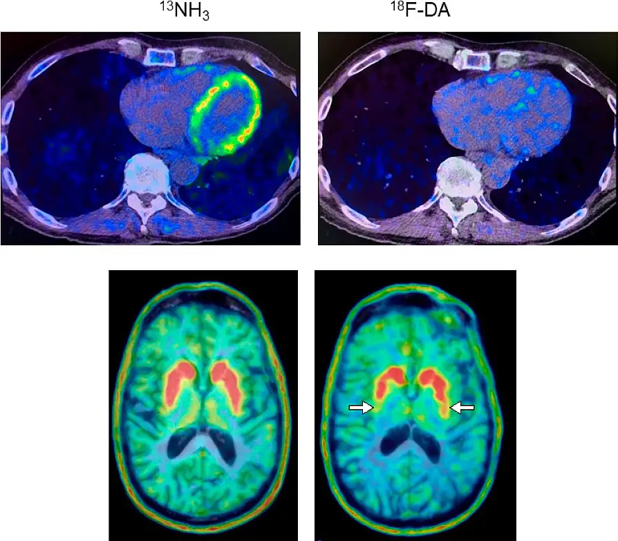 Heart-and-Brain-PET-Scans.webp