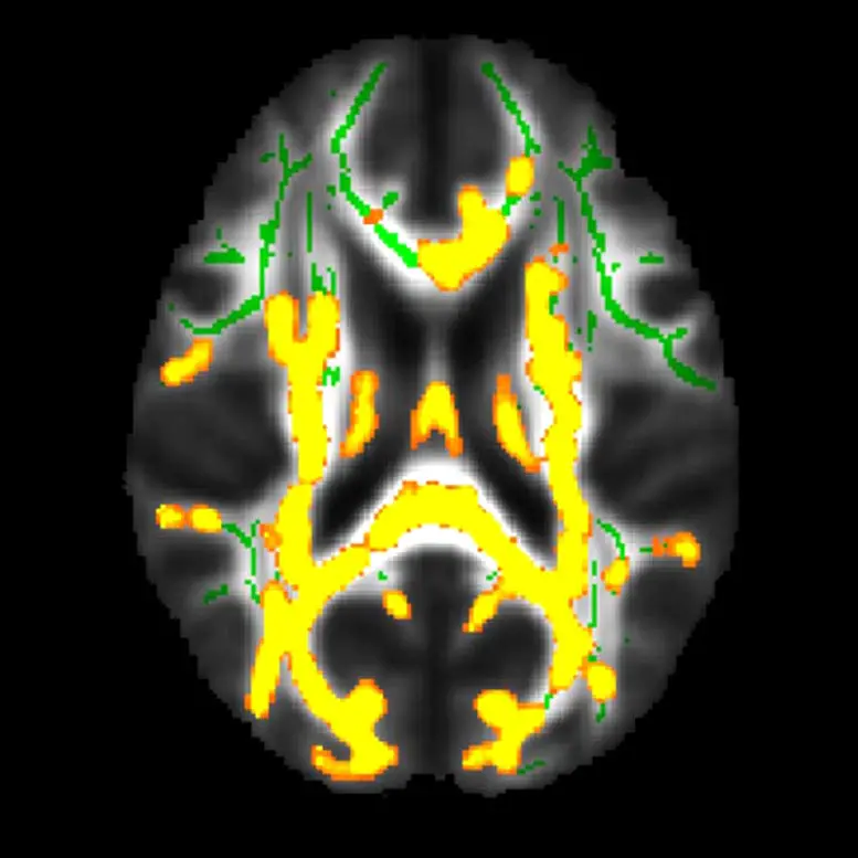 MRI-Shows-Increased-Neuroinflammation-Associated-With-Higher-Hidden-Fat.webp