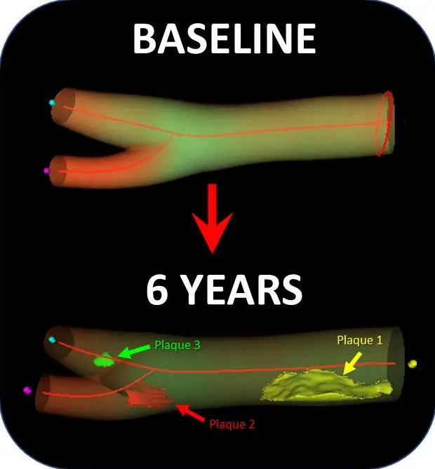 3-Dimensional-Ultrasound-Reconstruction-of-a-Carotid-Artery 图像，620x669 像素）.png