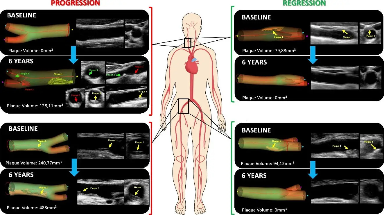 Representative-Results-From-Participants-Showing-Atherosclerosis-Progression-and-Regression-in-Arteries-of-the-Neck-and-Groin 图像，1322x740 像素）.jpg