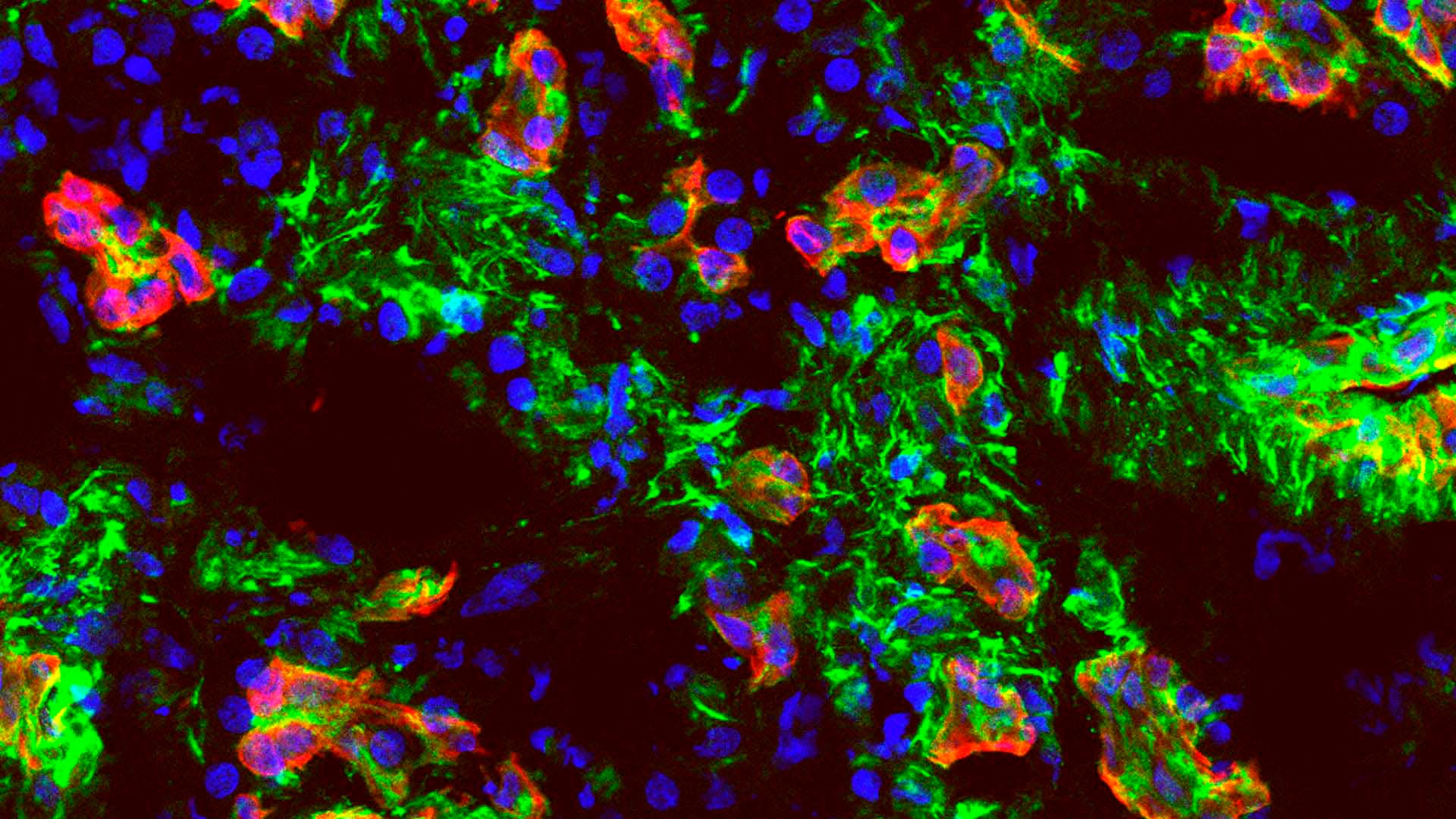 Pancreatic-Cancer-Cells-CSHL（JPEG 图像，1920x1080 像素） — 缩放 (81-.jpg