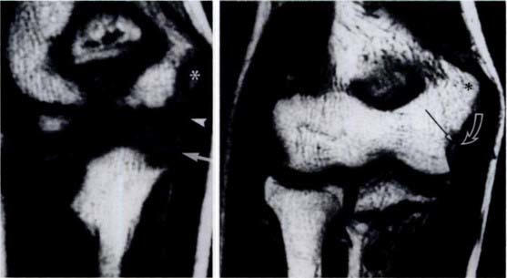Elbow-Growth-Plate-Image.jpg