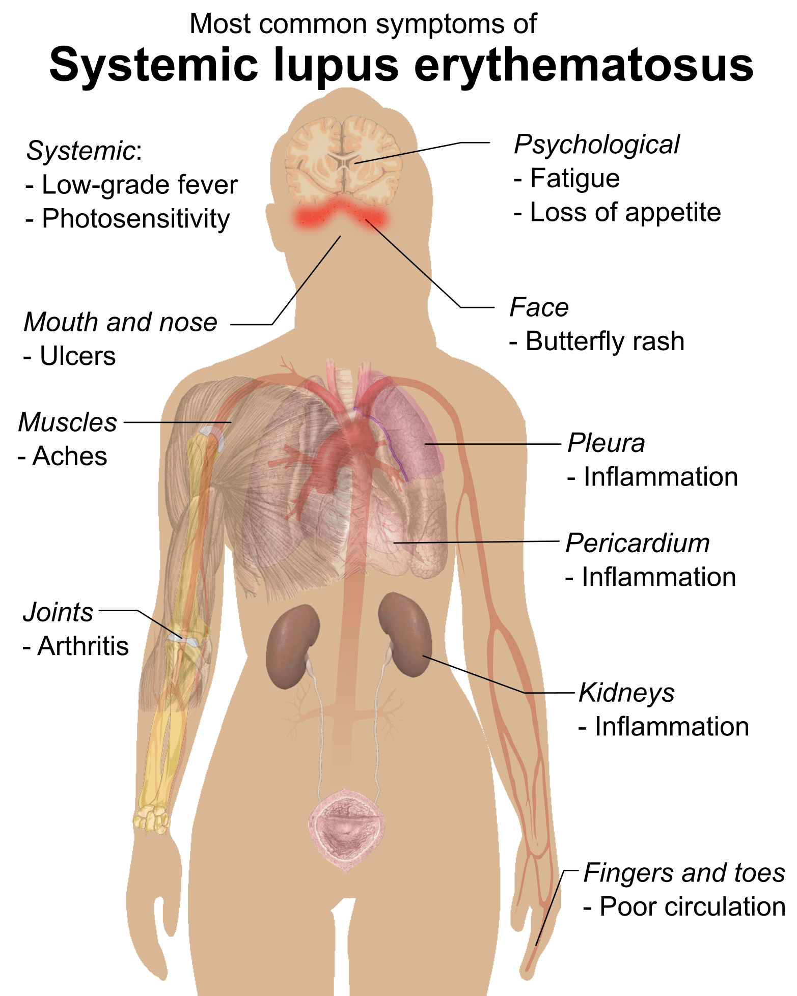Symptoms_of_SLE.png