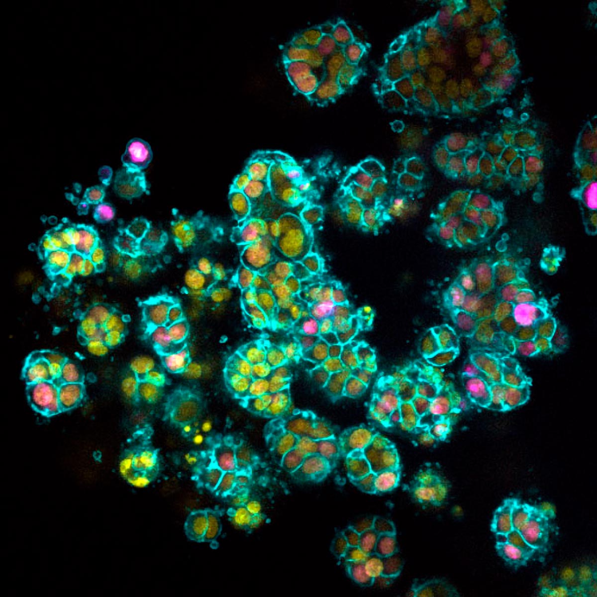 Pancreatic-Cancer-Cells-1.jpg