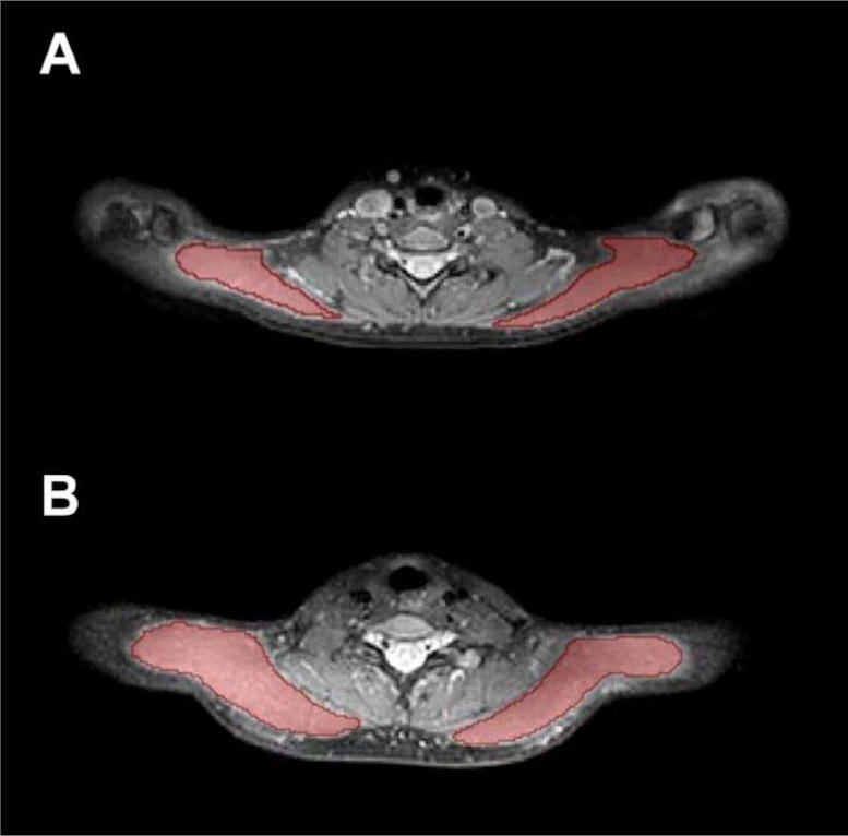 Exemplary-Cases-for-Trapezius-Muscle-Segmentations（JPEG 图像，777x766 像素）.jpg