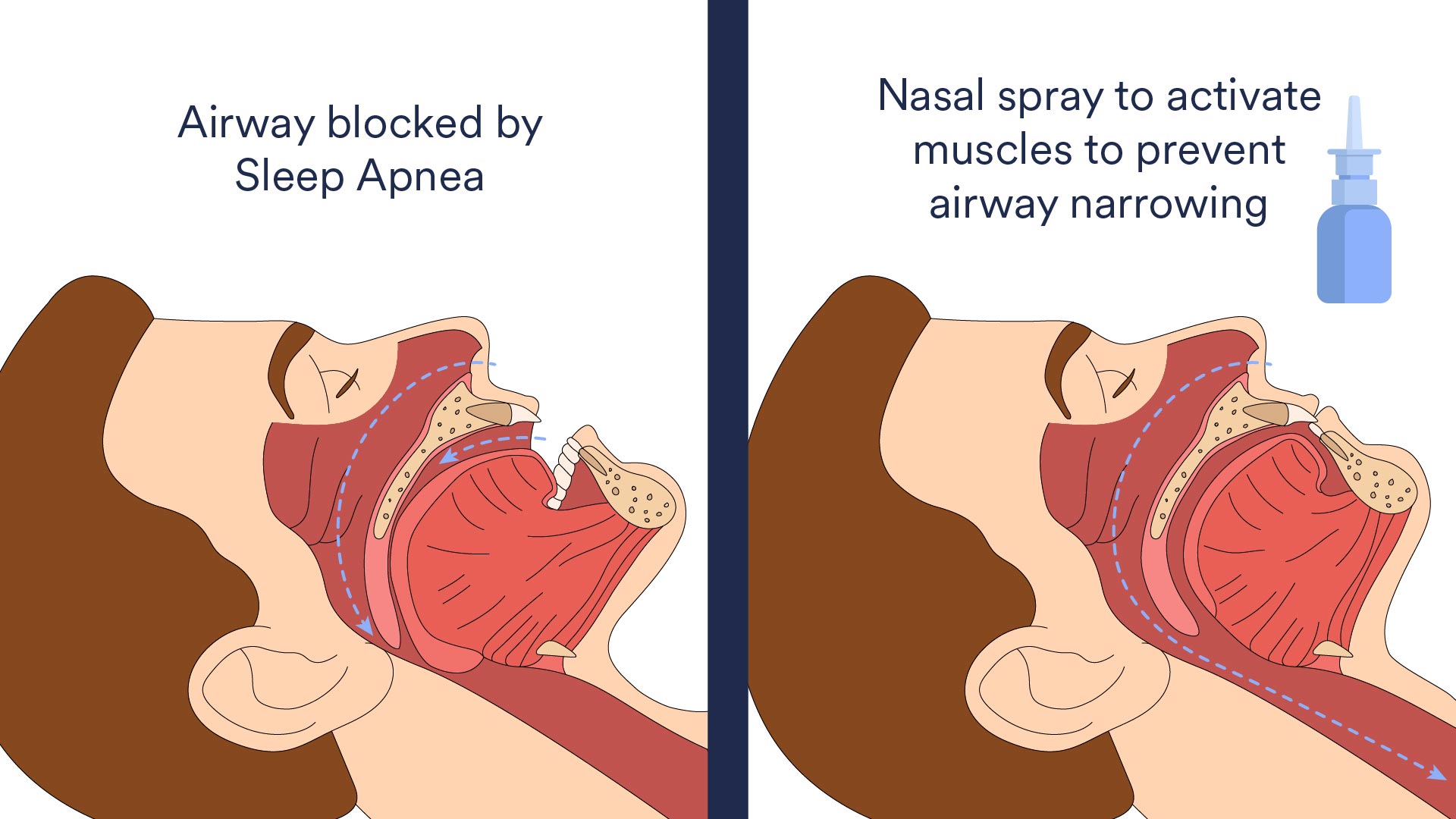 Sleep-Apnea-Nasal-Spray.jpg
