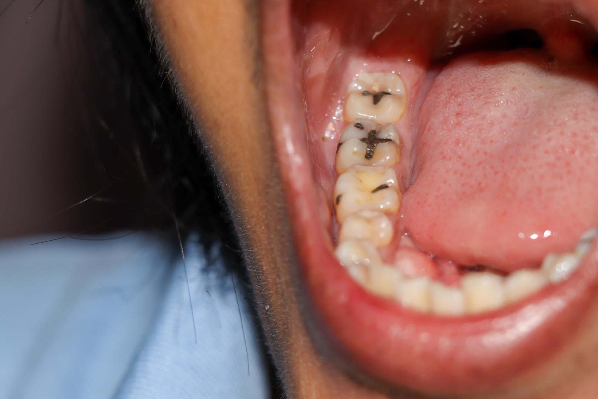 Open-Mouth-Teeth-Cavities.jpg