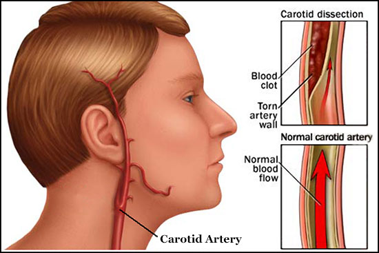 08-19-18Cervical-vertebral-artery-plaque.jpg