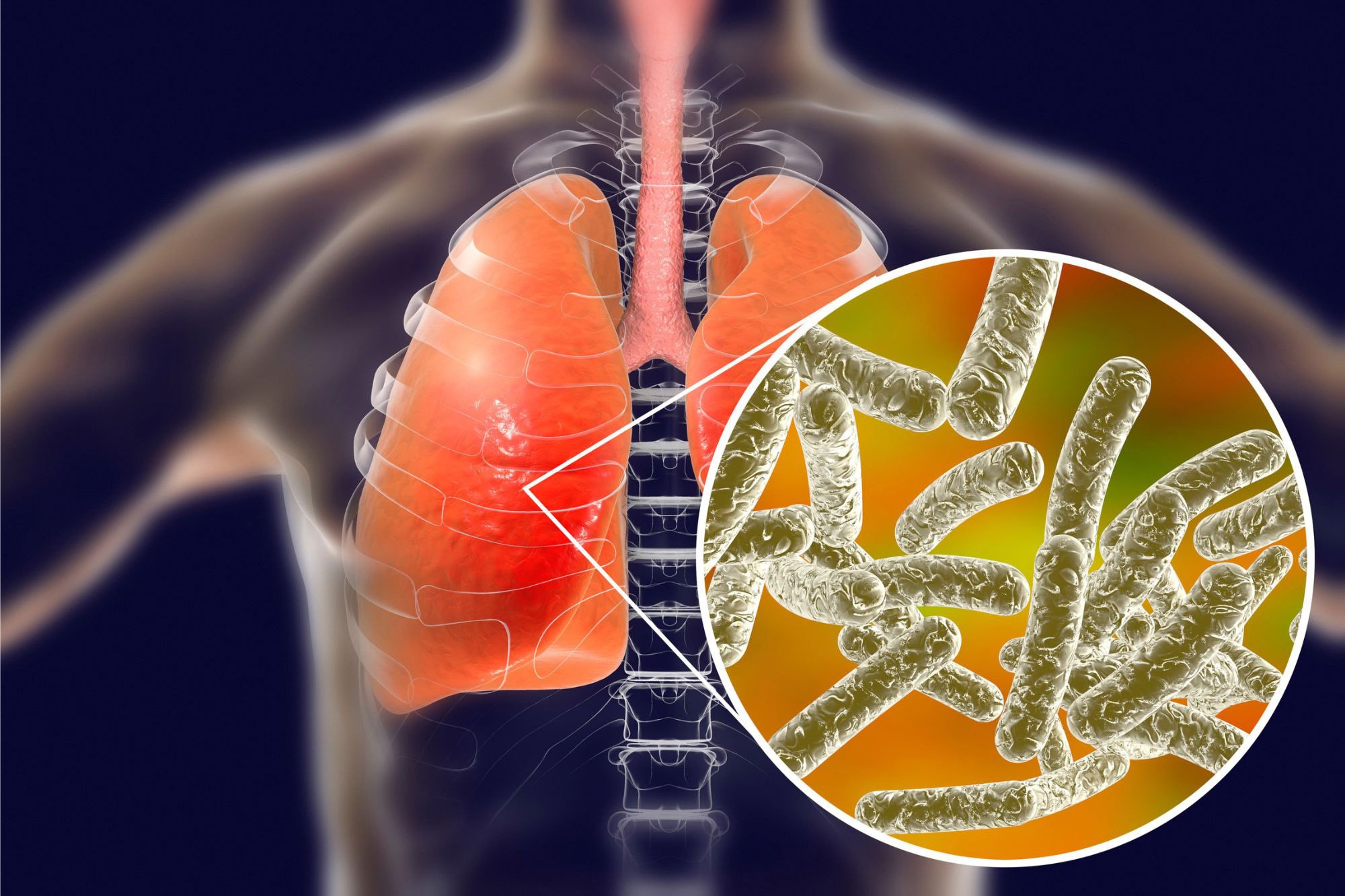 Legionnaires-Disease.jpg