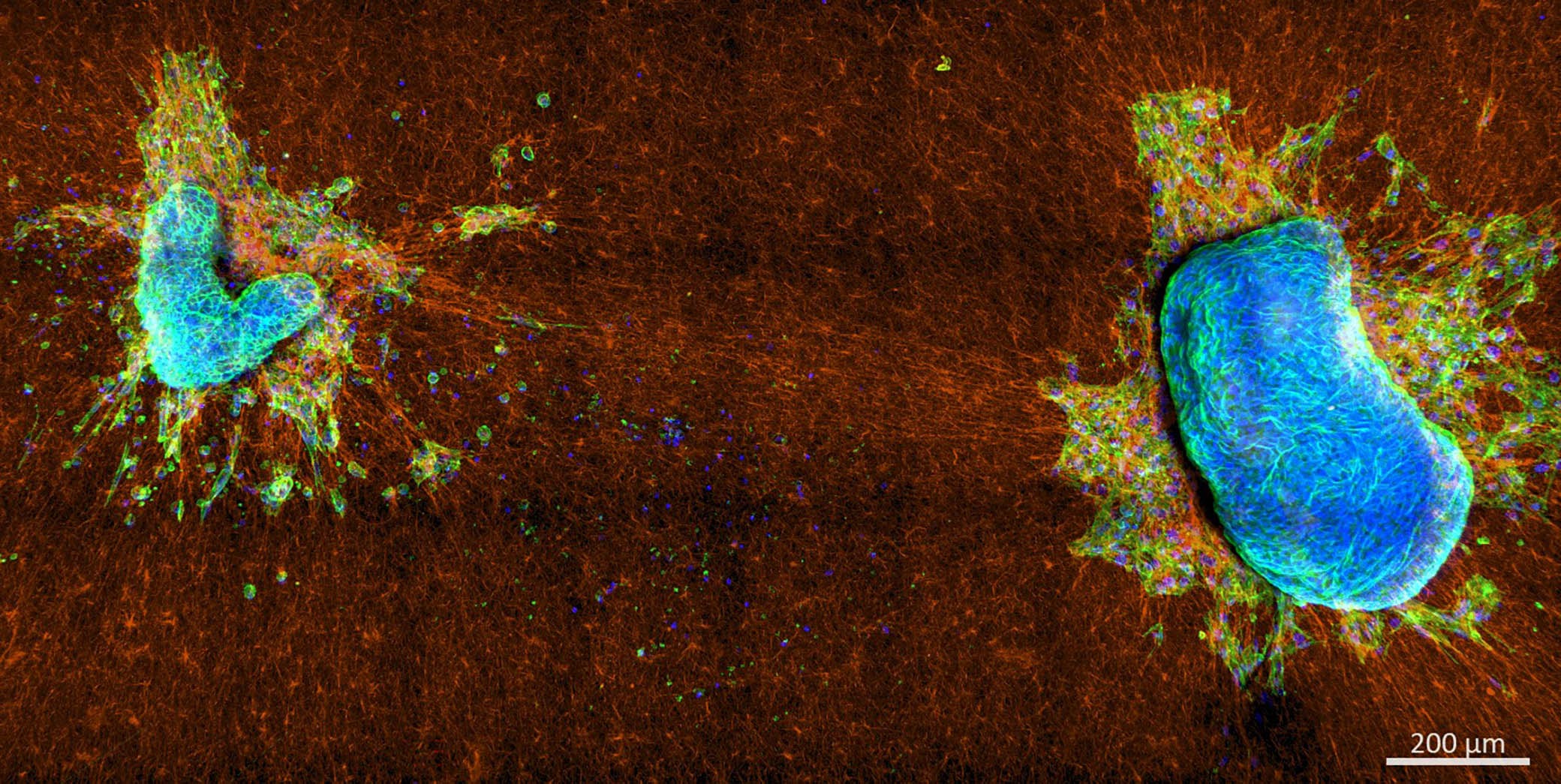 Two-Malignant-Mixed-Mullerian-Tumor-Explants-on-Collagen-Network.jpg